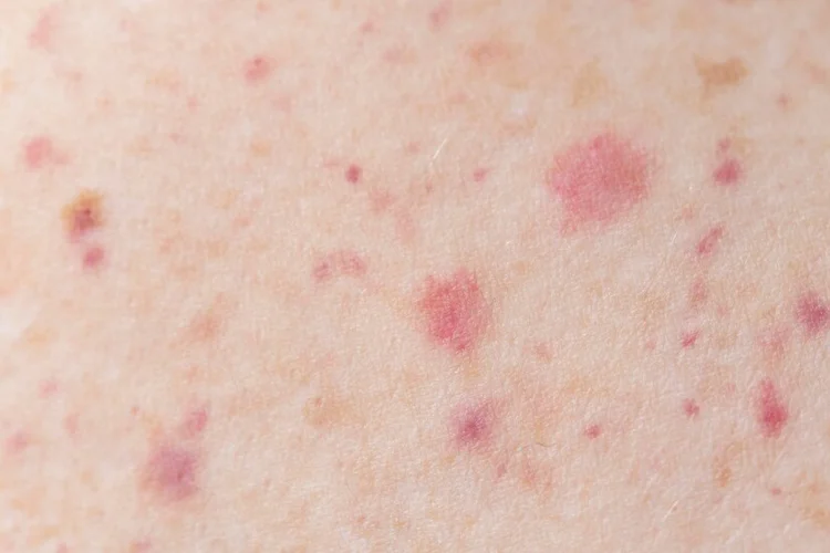 Close-up of rashes as a symptom of STD infection.