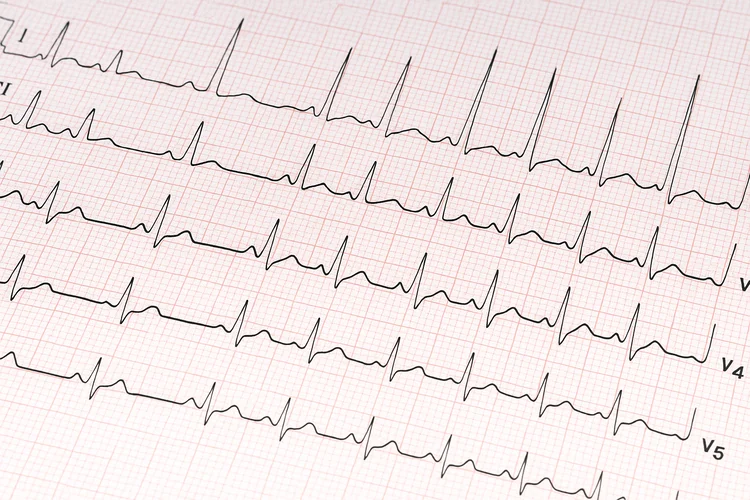 ECG result printout showing heart rhythm irregularities that may require a CT coronary angiogram.